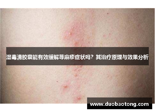 湿毒清胶囊能有效缓解荨麻疹症状吗？其治疗原理与效果分析